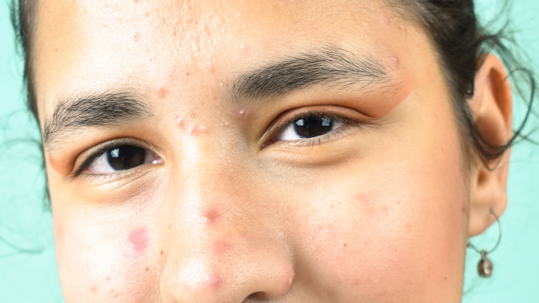 Close up image of person with pimples and blue background